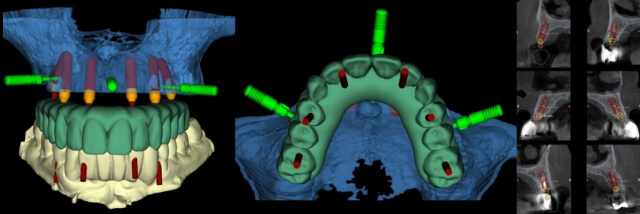 Digital implantology planing